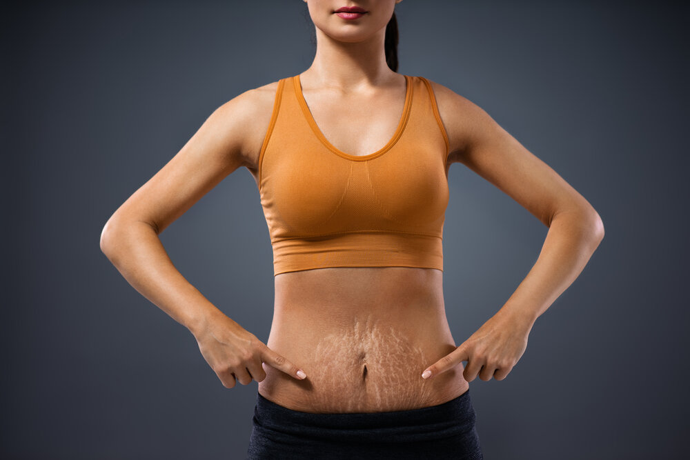 Mladá mamička po tehotenstve stojí a ukazuje na bruško plné strií