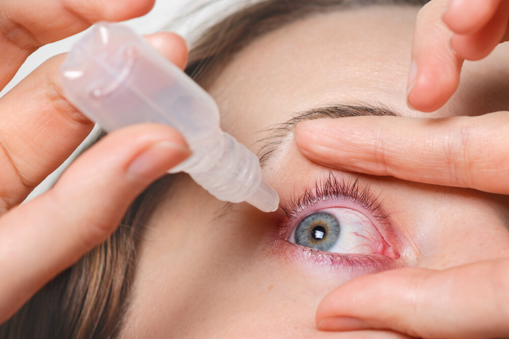 Detailný záber ženy, ktorá si nalieva kvapky do červených očí, má zápal spojiviek alebo jačmeň. Žena lieči červené krvné oko.