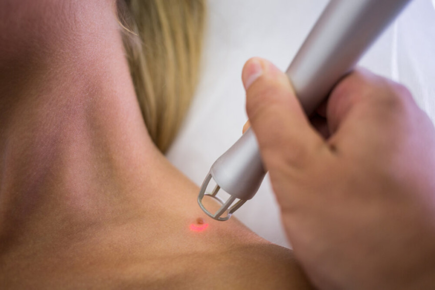 Dermatológ odstraňuje materské znamienka zo ženského ramena lekárskym laserom